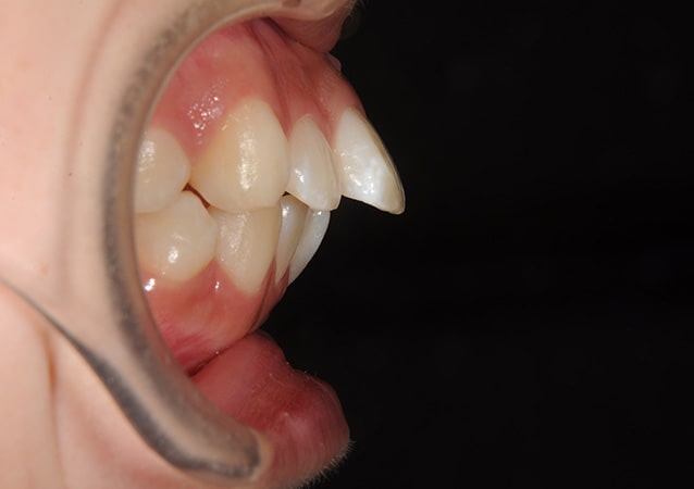 出っ歯の症状例写真