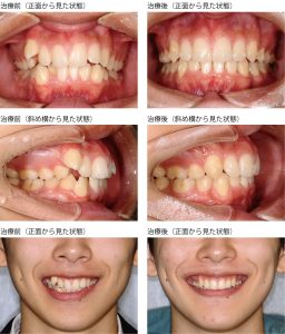 八重歯の症例 写真