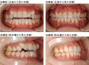 八重歯症例