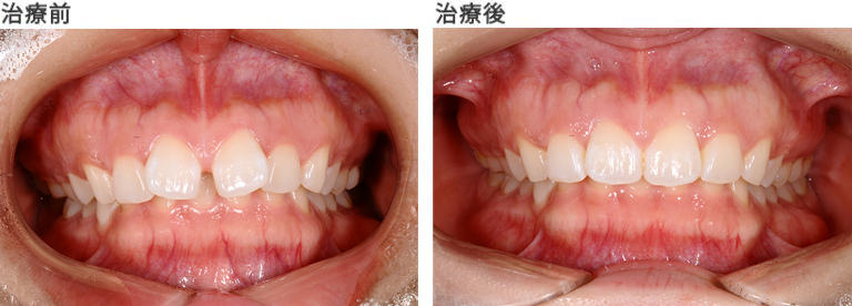 すきっ歯　治療前と治療後
