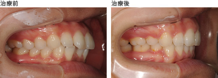 口ゴボ　治療前と治療後の歯並び