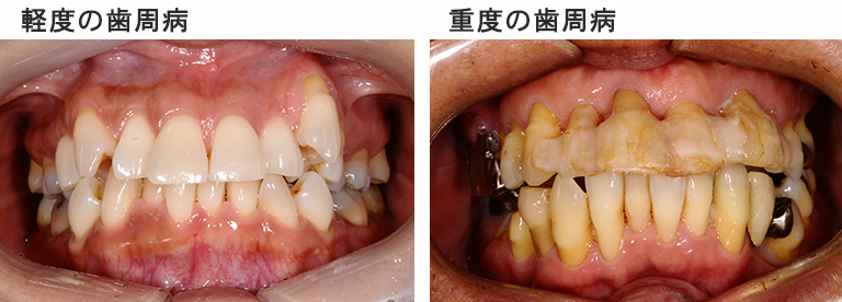 軽度の歯周病と重度の歯周病