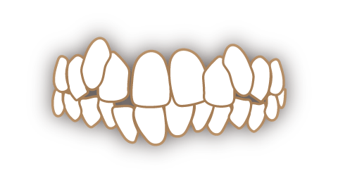 八重歯（叢生・乱杭歯）の歯並び