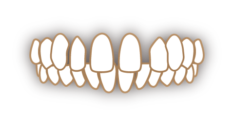 空隙歯列弓の歯並び