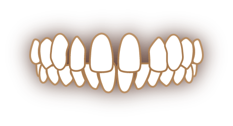 すきっ歯（空隙歯列弓）の歯並び
