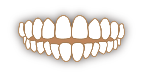 上下の歯のすき間（開咬）の歯並び