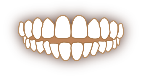 上下の歯のすき間（開咬）の歯並び