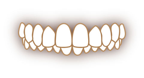 過蓋咬合の歯並び