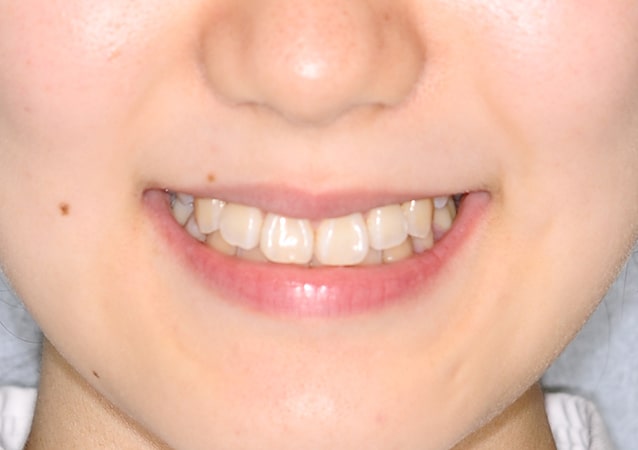 八重歯・ガチャ歯・ガタガタ歯 矯正 症例 写真01 顔 治療後