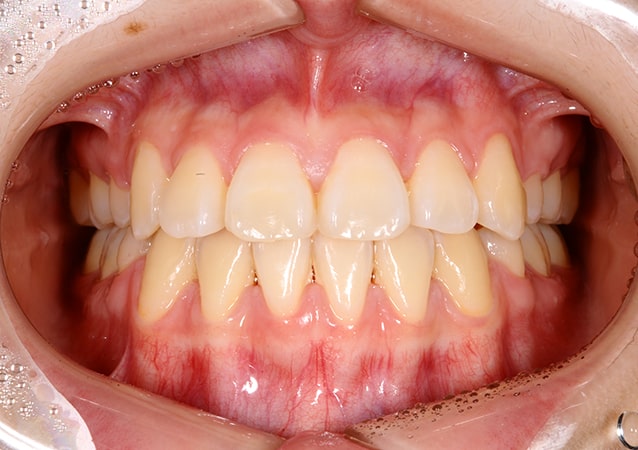 八重歯・ガチャ歯・ガタガタ歯 矯正 症例 写真01 正面 治療後