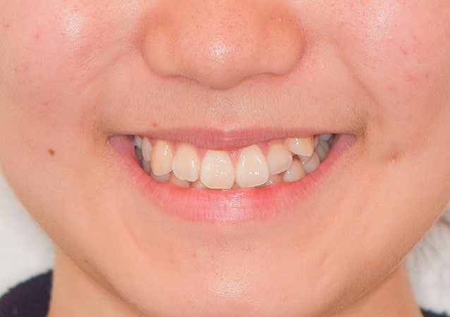 八重歯・ガチャ歯・ガタガタ歯 矯正 症例 写真01 顔 治療前