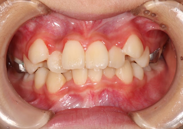 八重歯・ガチャ歯・ガタガタ歯 矯正 症例 写真02 正面 治療前