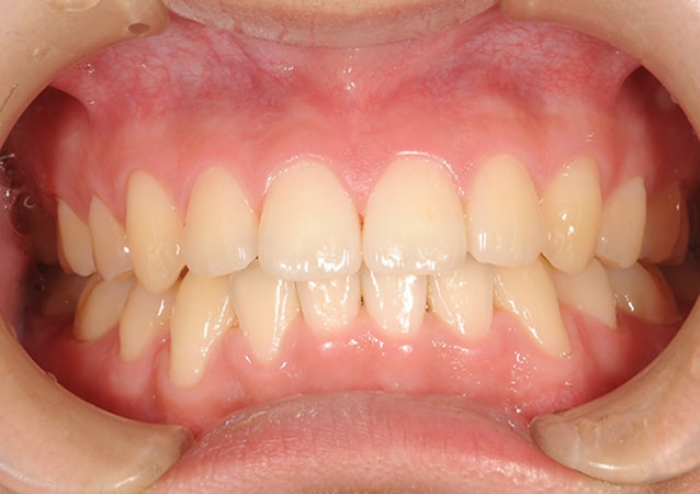 八重歯・ガチャ歯・ガタガタ歯 矯正 症例 写真03 正面 治療後