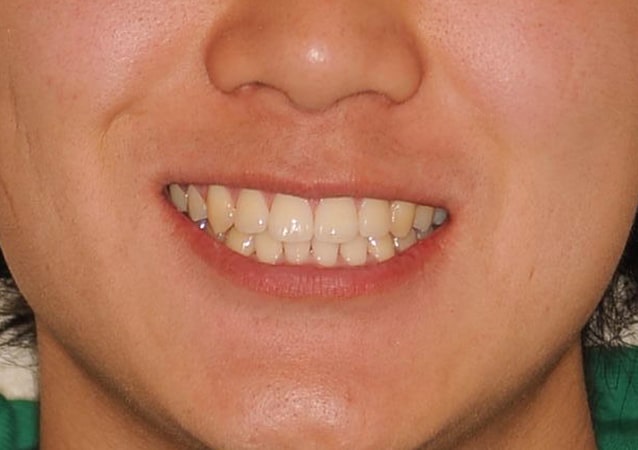 八重歯・ガチャ歯・ガタガタ歯 矯正 症例 写真03 正面 治療後