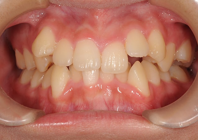 八重歯・ガチャ歯・ガタガタ歯 矯正 症例 写真03 正面 治療前