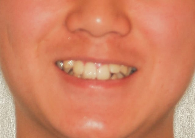 八重歯・ガチャ歯・ガタガタ歯 矯正 症例 写真03 正面 治療前