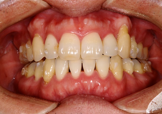 八重歯・ガチャ歯・ガタガタ歯 矯正 症例 写真04 正面 治療後