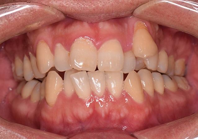 八重歯・ガチャ歯・ガタガタ歯 矯正 症例 写真04 正面 治療前