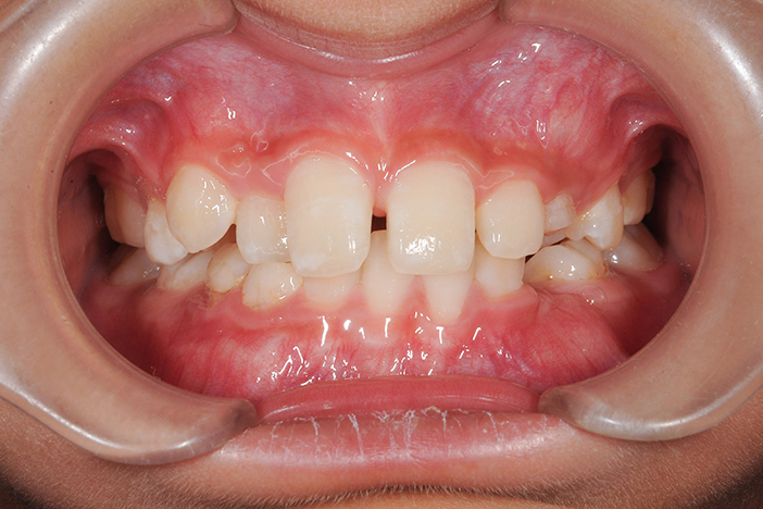 咬み合わせが深い歯（過蓋咬合）の治療前の正面から見た状態