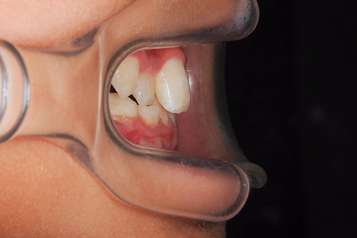 咬み合わせが深い歯（過蓋咬合）の治療前の真横から見た状態