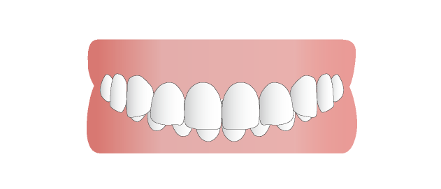 咬み合わせが深い歯（過蓋咬合）の症状