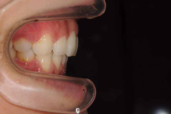 大阪 矯正歯科 淀屋橋矯正歯科 口ゴボ 治療前の真横から見た状態