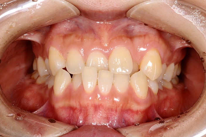 受け口 反対咬合 下顎前突 治療前の真横から見た状態