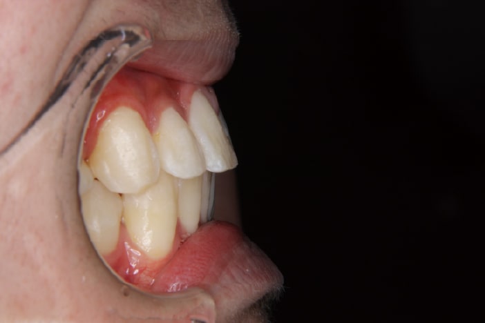 大阪の矯正歯科 淀屋橋矯正歯科 上顎前突 治療後の真横から見た状態