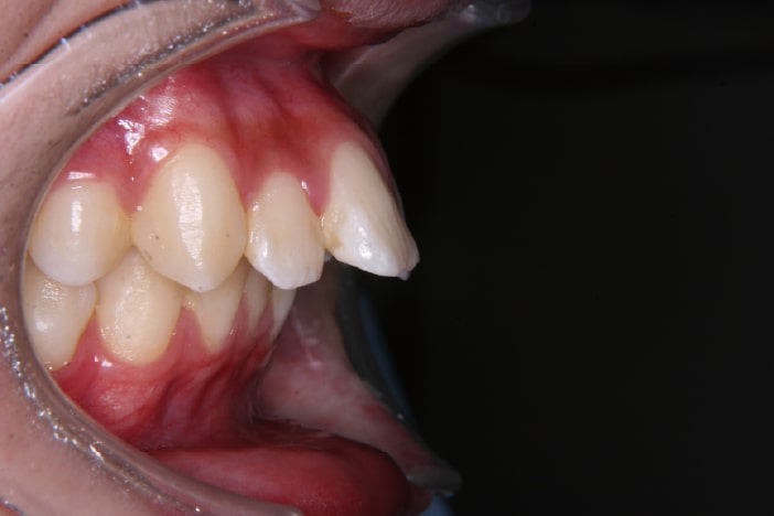 大阪の矯正歯科 淀屋橋矯正歯科 上顎前突 治療前の真横から見た状態