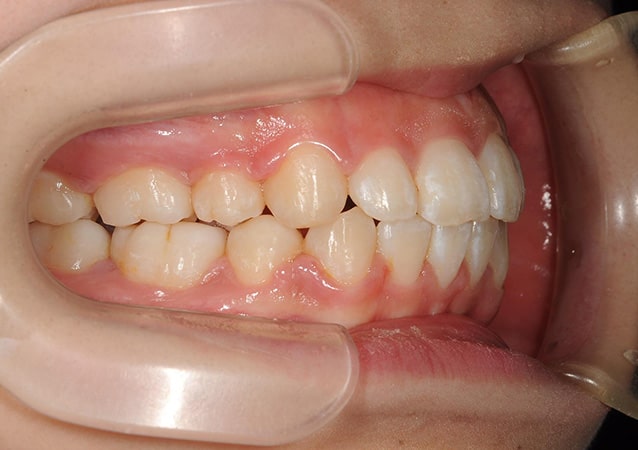出っ歯 矯正 症例 写真01 斜め 治療後