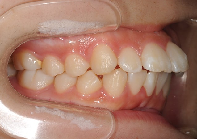 出っ歯 矯正 症例 写真01 斜め 治療前