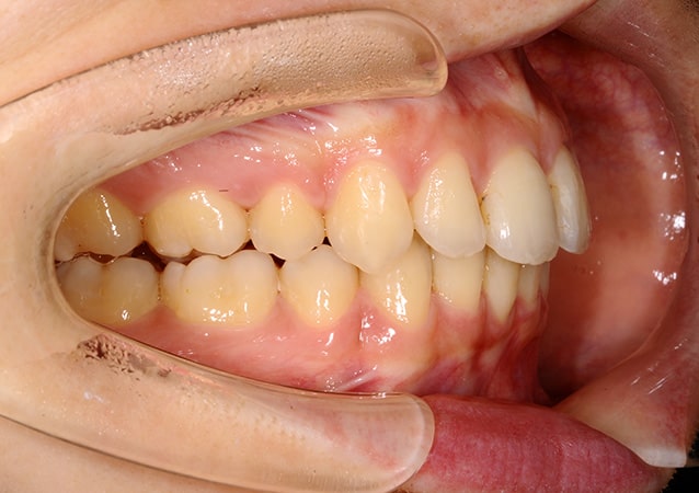 出っ歯 矯正 症例 写真02 斜め 治療後
