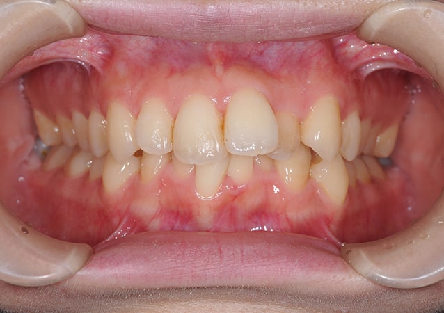 出っ歯 矯正 症例 写真02 正面 治療前