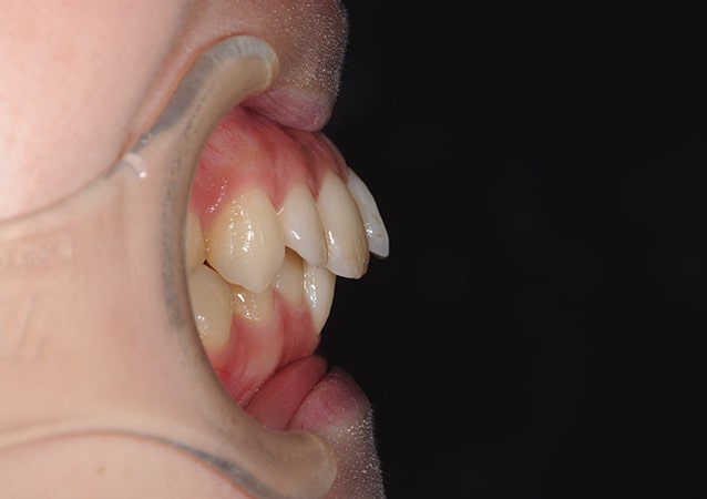 出っ歯 矯正 症例 写真02 横 治療前