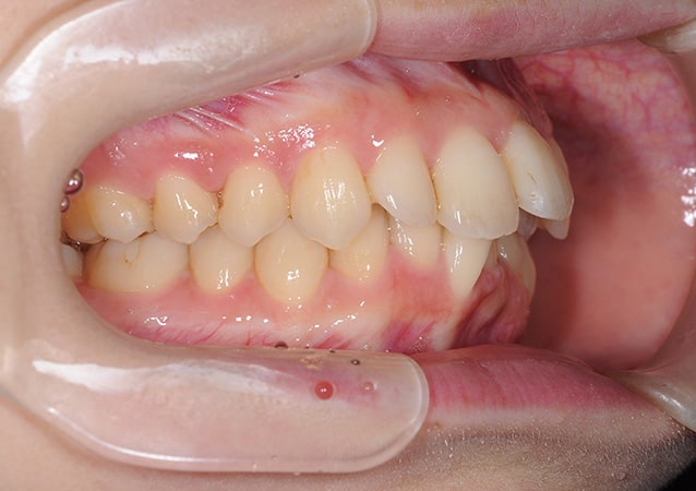 出っ歯 矯正 症例 写真02 斜め 治療前