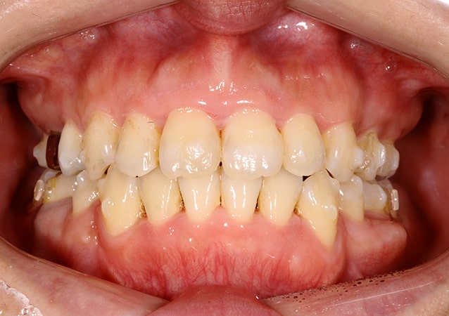出っ歯 矯正 症例 写真03 正面 治療後