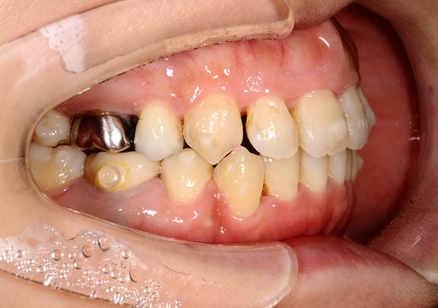 出っ歯 矯正 症例 写真03 斜め 治療後