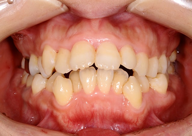 出っ歯 矯正 症例 写真03 正面 治療前