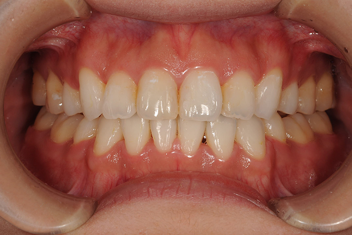 上下の歯のすき間（開咬）治療前の正面から見た状態
