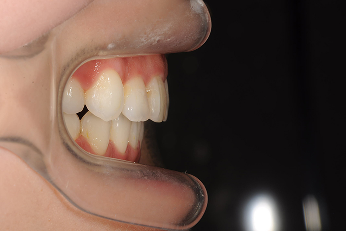 上下の歯のすき間（開咬）の治療前の真横から見た状態