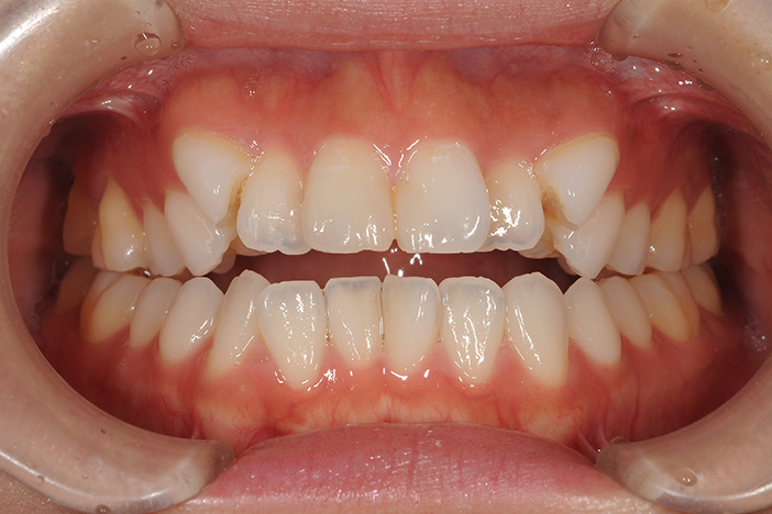 上下の歯のすき間（開咬）の治療前の正面から見た状態