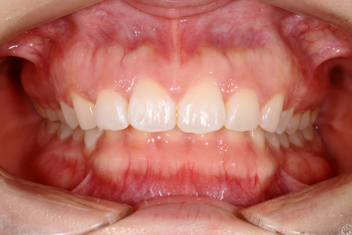 すきっ歯（空隙歯列弓） 治療前の正面から見た状態