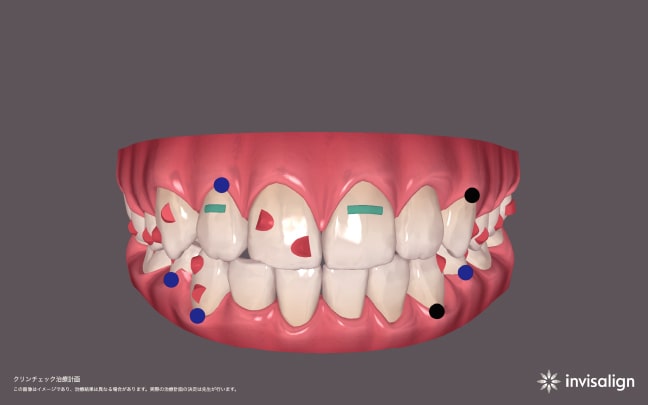 大阪の矯正歯科 淀屋橋矯正歯科 iTeroエレメント（アイテロエレメント）で口腔内をスキャンしたデータ