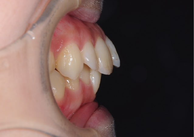 大阪の矯正歯科 淀屋橋矯正歯科 表側矯正 治療前の真横から見た状態