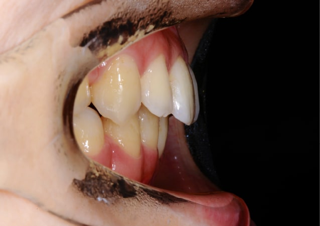 大阪の矯正歯科 淀屋橋矯正歯科 表側矯正 治療後の真横から見た状態