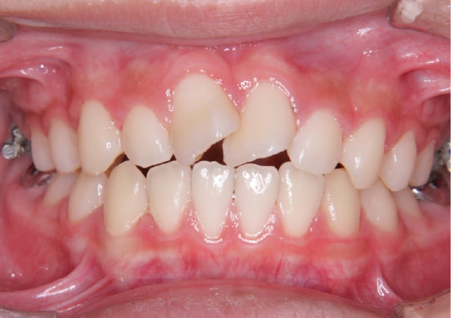 大阪 矯正歯科 淀屋橋矯正歯科 表側矯正 治療前の正面から見た状態