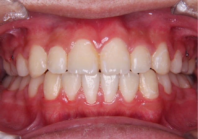 大阪 矯正歯科 淀屋橋矯正歯科 表側矯正 治療前の真横から見た状態