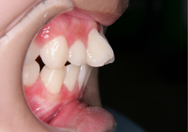 大阪の矯正歯科 淀屋橋矯正歯科 表側矯正 治療後の正面から見た状態