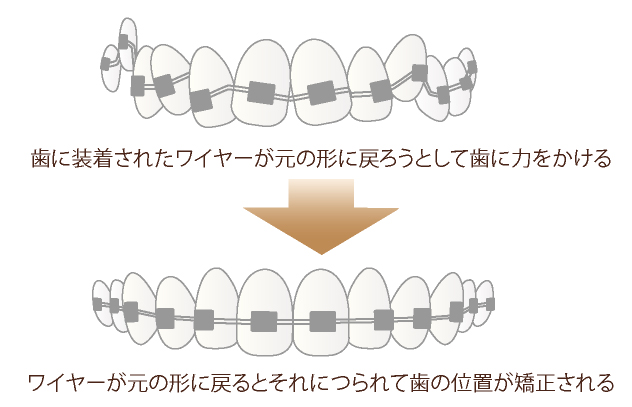ワイヤー矯正（表側矯正）で歯が移動する仕組み