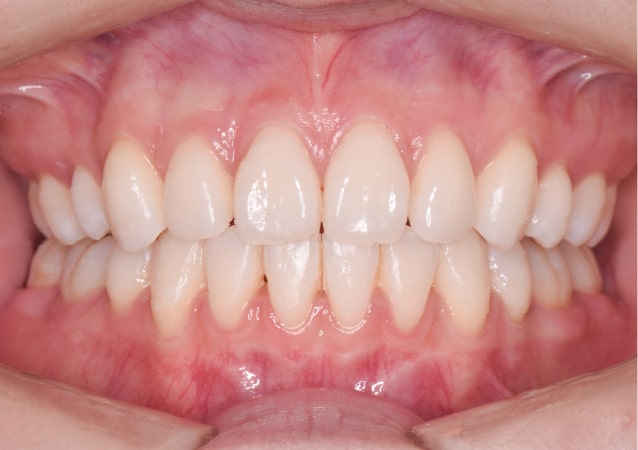 大阪 矯正歯科 淀屋橋矯正歯科 裏側矯正 治療後の正面から見た状態